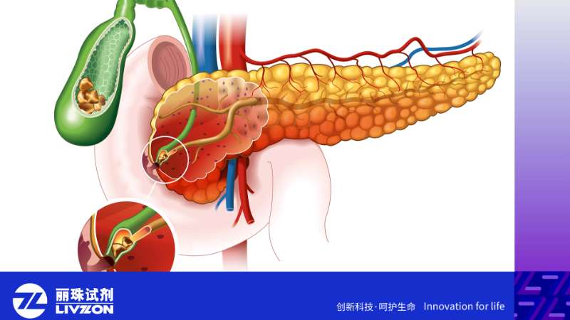 世界胰腺癌日 | CA199升高，一定是得了胰腺癌吗？